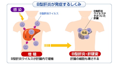 B型肝炎